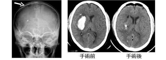 院長コラム：脳出血について(5)