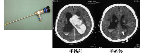 院長コラム：脳出血について(5)