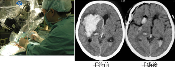 院長コラム：脳出血について(5)