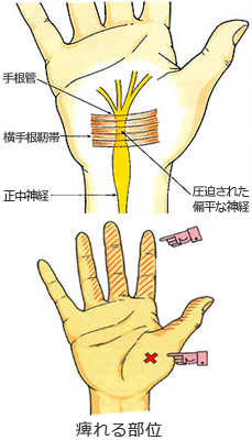 院長コラム：しびれ(5)