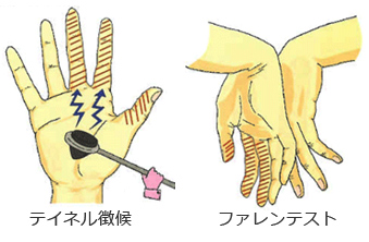 院長コラム：しびれ(5)