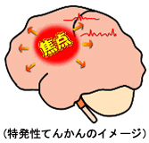 院長コラム：てんかんについて(1)